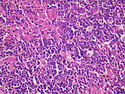 Pathology Outlines - Chronic lymphadenitis