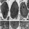 Lymphoma cells and granule-like structures