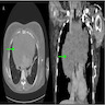 Large anterior mediastinal mass