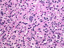 Pathology Outlines - Lymphocyte depleted classic Hodgkin lymphoma