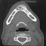 Pathology Outlines - Ameloblastoma