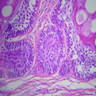 Pathology Outlines - Metastasizing ameloblastoma