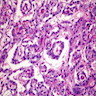 Pathology Outlines - Germ cell tumors