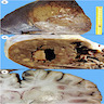 Lung pathology