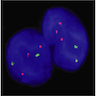 Trisomy 21