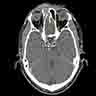 Contrast CT of a soft tissue mass