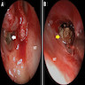 Brown mass on endoscope