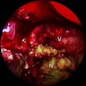 Endoscopic view