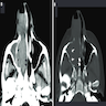 CT and MRI, sinonasal SCC