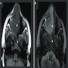 CT and MRI, sinonasal SCC