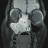 CT and MRI, sinonasal SCC