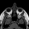 MRI, sinonasal squamous cell carcinoma