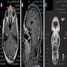 Periorbital sinonasal SCC