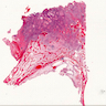 Squamous cell carcinoma, head and neck