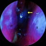 Nasoendoscopy of sphenoid sinus mass