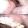 Nasoendoscopy of maxillary sinus mass