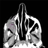 CT of maxillary sinus mass
