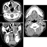 CT / MRI of maxillary sinus mass