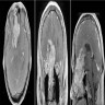 Brain MRI with Gadolinium scan