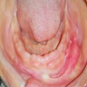 Hyperplastic tissue mandibular alveolar ridge