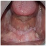 Hyperplastic tissue mandibular alveolar ridge