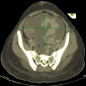 Computed tomography of pelvic mass