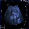 Dermoid cyst with heterogeneous echotexture