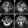 Adnexal heterogeneous masses