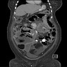 Adnexal heterogeneous masses