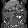 Adnexal heterogeneous masses