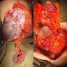 Teratoma with metastatic nodules