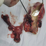 Abscessed left ovarian tumor