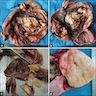 Mature teratoma