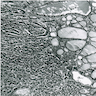 Pathology Outlines - Strumal carcinoid