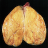 Pathology Outlines - Steroid cell tumor