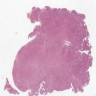 Epithelioid mesothelioma