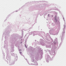 Epithelioid mesothelioma