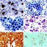 Mesothelial cells cytologic features