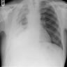 Pleural effusion with thickening