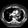 Pleural thickening invading pericardium