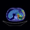 Pleural and nodal uptake