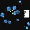 Homozygous CDKN2A deletion