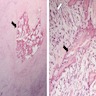 Pathology Outlines - Mesothelioma-sarcomatoid