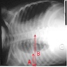 Chest Xray