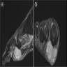 Subcutaneous tumor MRI