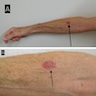 Erythematous macule on forearm