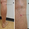 Erythematous papule on posterior calf