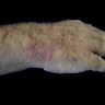 Erythematous plaque on wrist