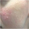 Multiple skin colored papules on the cheeks