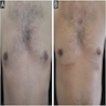 Bilateral chest tinea versicolor